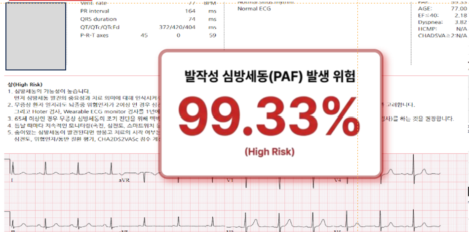 대학병원 외래 진료 : 간헐적 어지러움 가습답답함 호소, 심전도는 Normal, NSR (75y, Female) Thumbnail